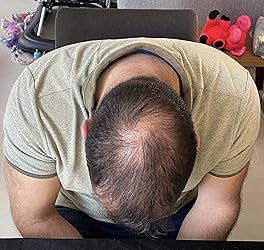 Sérum Capillaire Revitalisant Anti-Chute NamilKa pour Repousse et Cheveux Denses